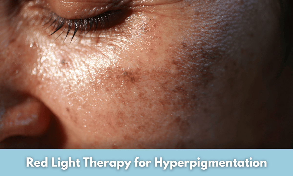 Red Light Therapy for Hyperpigmentation Does It Work Glowastica