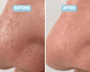 Skin Scraping Tool for Blackheads Before and After