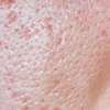Large Pores on Skin