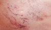 Mottled Skin on Leg