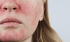 Pink Splotches on Skin and Face