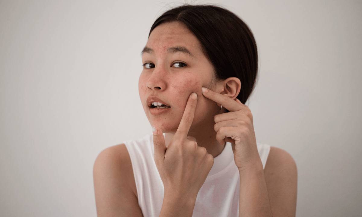 Understanding Hormonal Acne: Unraveling the Causes – Glowastica
