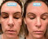 led face sculpting tool before and after