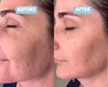 ultrasonic face sculpting tool before and after
