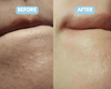 Face Scraping for Blackheads Before and After